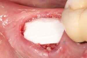 Dr. Bublik Dec. 7 case_graft and membrane at placement