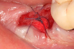 Dr. Bublik Dec. 7 case_suturing at placement