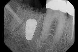 Dr. Bublik Dec. 7 case_xray 18 mo. after placement