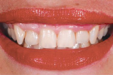 Accurate Dental Implants