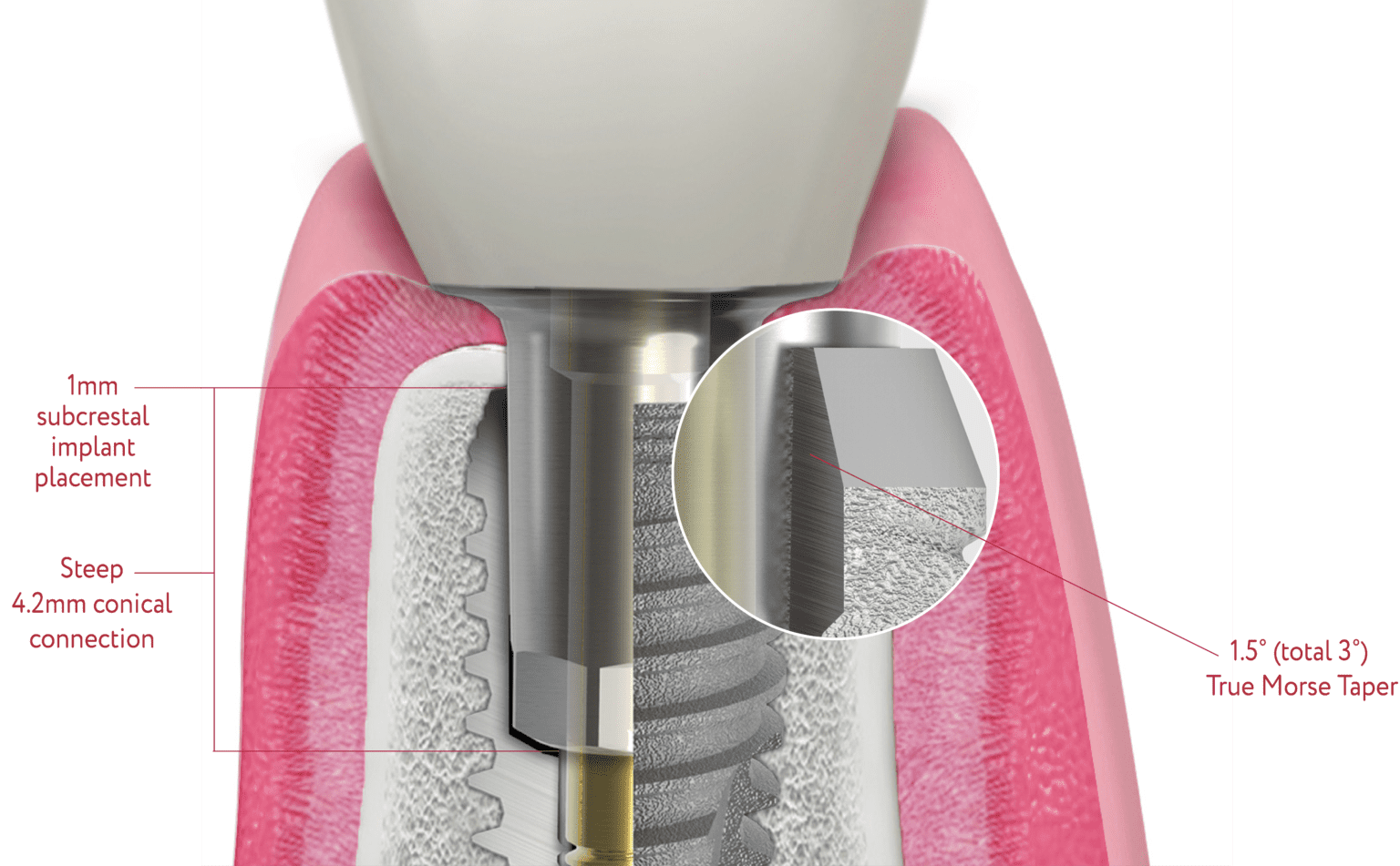 Argon K3 Pro Complete Dental Implant Solutions